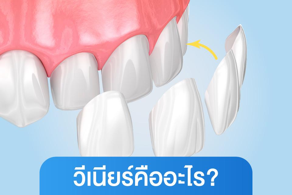 วีเนียร์ vs ครอบฟัน เลือกแบบไหนให้เหมาะกับฟันคุณ