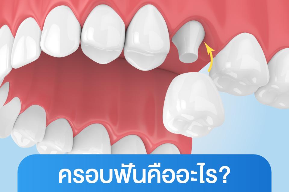 วีเนียร์ vs ครอบฟัน เลือกแบบไหนให้เหมาะกับฟันคุณ