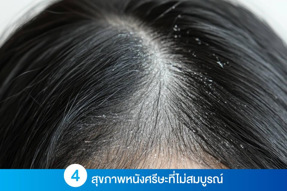 ผมร่วงแบบไม่รู้ตัว 4 สัญญาณเตือนที่ควรระวัง